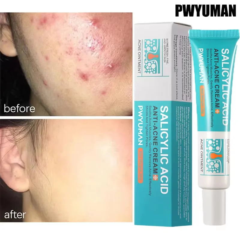 Advanced Pore Refining Acne Treatment