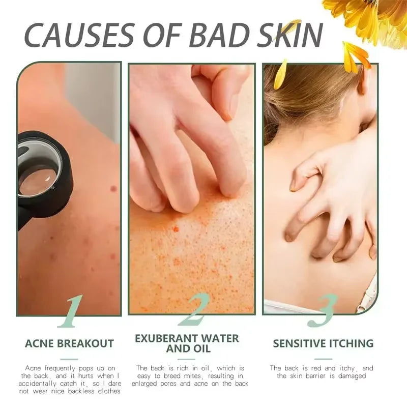 Advanced Pore Refining Acne Treatment