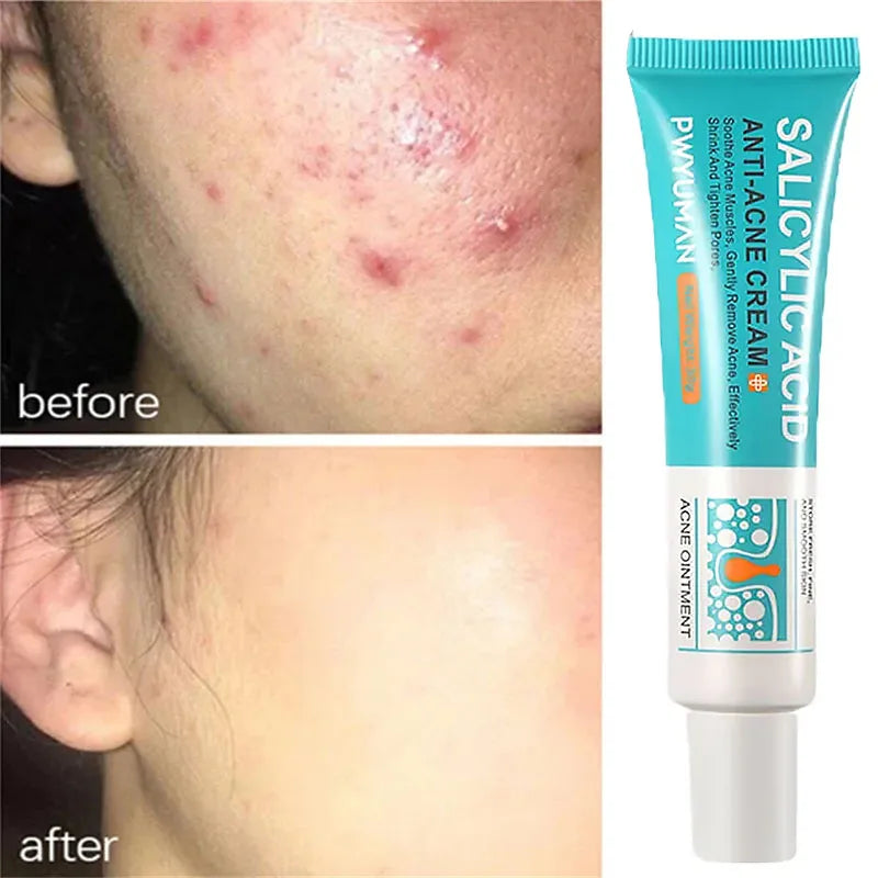 Advanced Pore Refining Acne Treatment