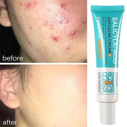 Advanced Pore Refining Acne Treatment