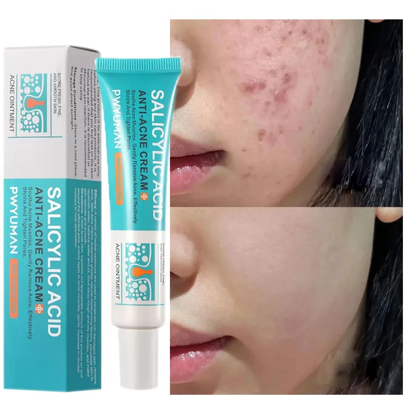 Advanced Pore Refining Acne Treatment
