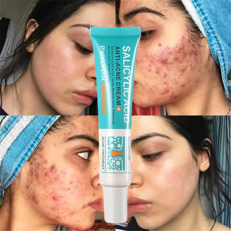 Advanced Pore Refining Acne Treatment