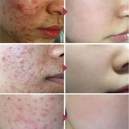 Advanced Pore Refining Acne Treatment