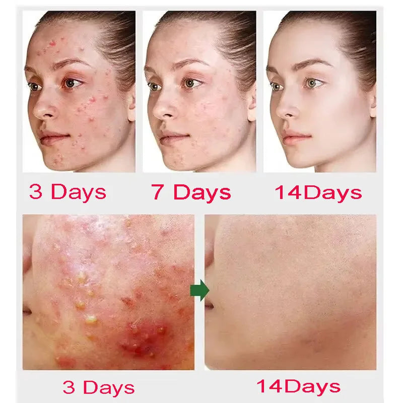 Advanced Pore Refining Acne Treatment