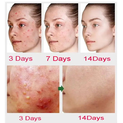 Advanced Pore Refining Acne Treatment